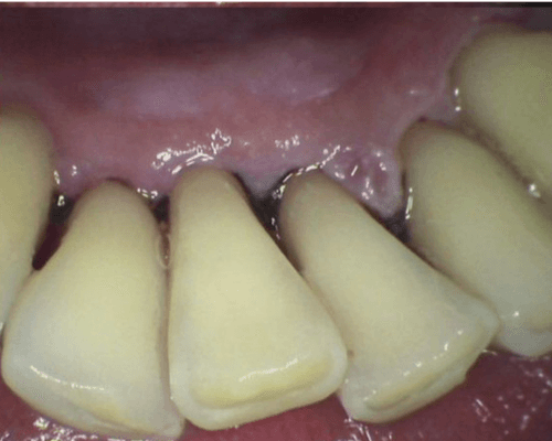 Scaling + Pembersihan Stain after treatment