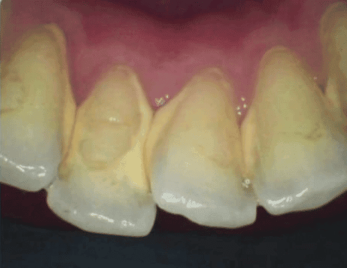 Scaling Gigi before treatment