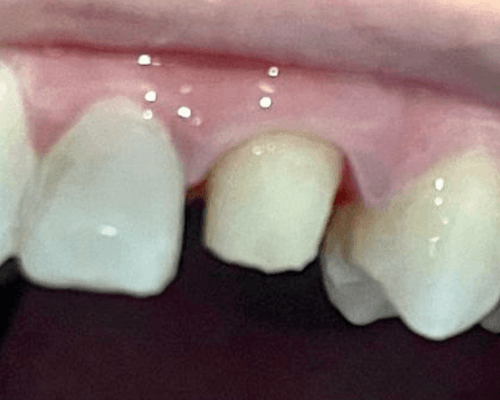 Tambal Gigi Anak + Crown before treatment